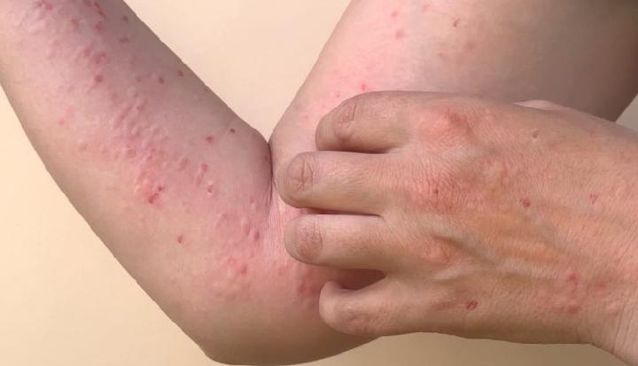 Kemenkes: Kasus Monkeypox Bertambah dalam Indonesia, Akibat Seks Berisiko